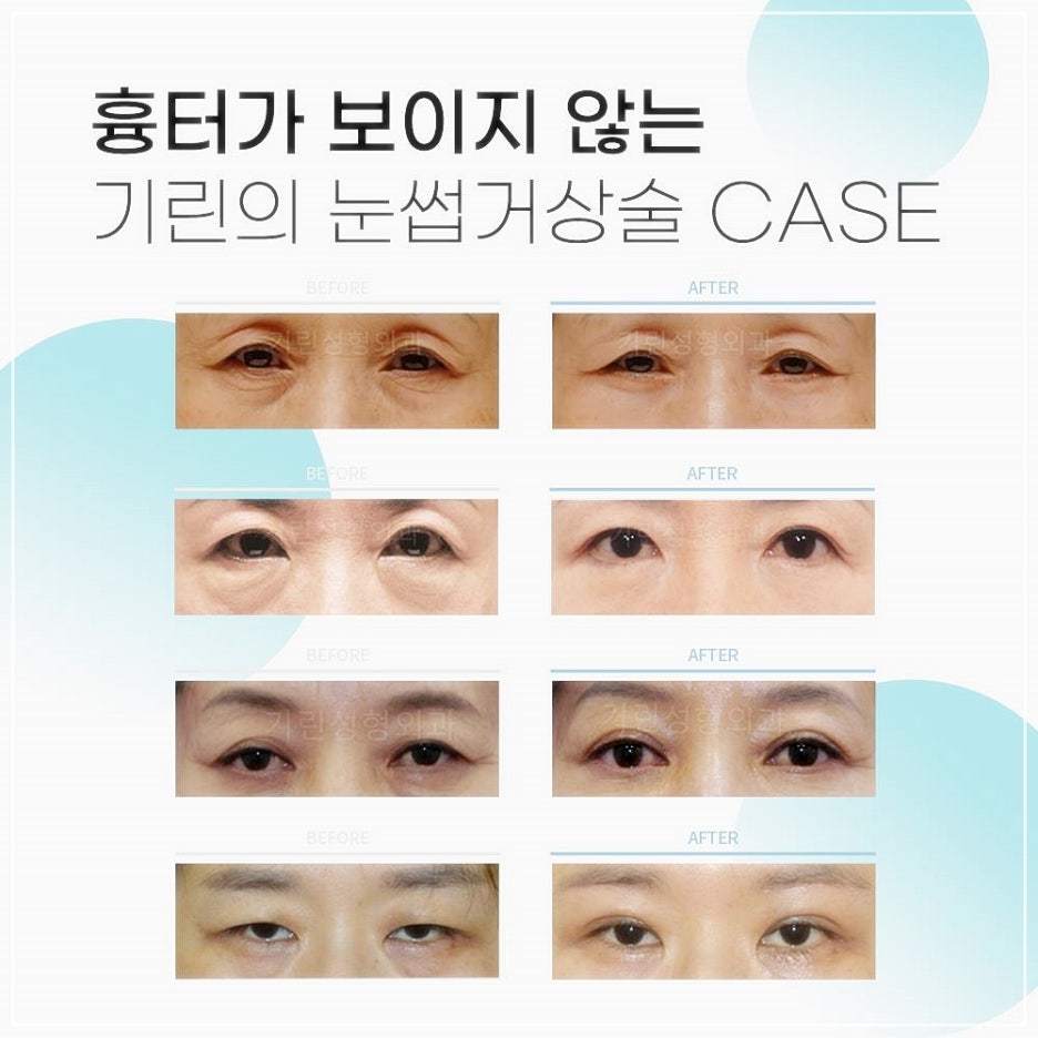 눈썹리프팅 나만알던 동안비결 관련 이미지 5