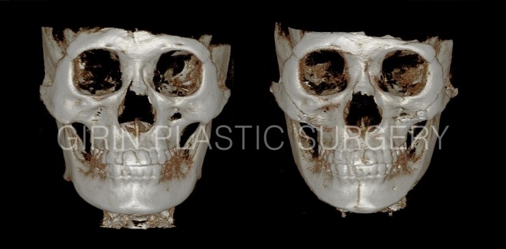광대고정, 긴곡선절제(넓은턱) 케이스 관련 이미지 1