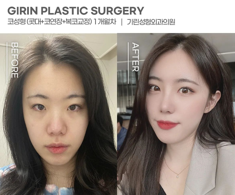 코성형 종류 비교하고 맞춰서 관련 이미지 8