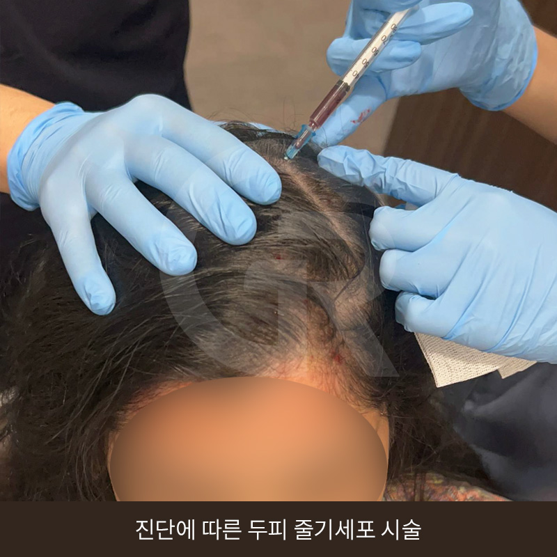 탈모 고민 두피 줄기세포 치료, 가격이 다른 이유는? 관련 이미지 1