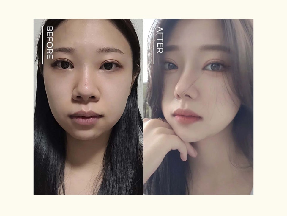 코성형외과유명한곳 조화롭게 달라지는 관련 이미지 6