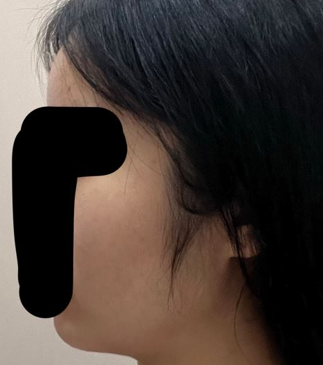 연조직윤곽술 후기, 볼살보다 신경 쓰였던 턱선 변화 관련 이미지 6