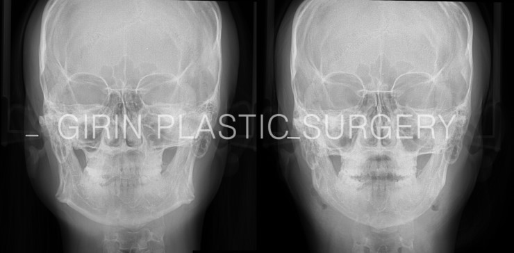 볼살과 턱이 발달한 케이스 관련 이미지 4