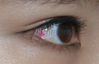 쌍꺼풀수술: 티안나는 쌍꺼풀수술 관련 이미지 2