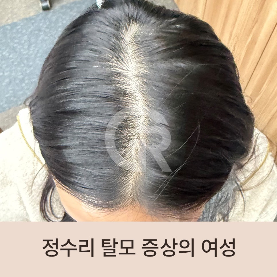 "머리숱이 없어요" 가르마 탈모 환자 줄기세포 주사 관련 이미지 1
