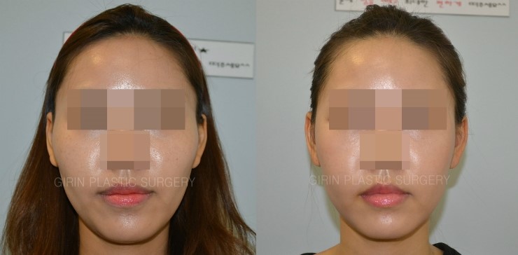 광대고정술 21일 경과 관련 이미지 1