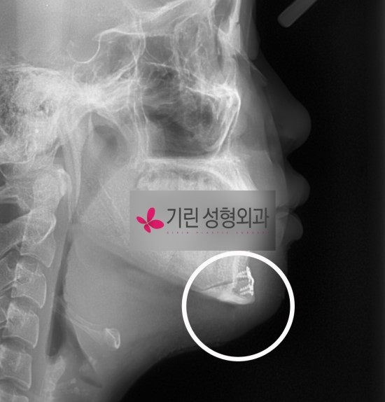 안면윤곽수술의 대표적인 사각턱과 앞턱(엑스레이사진) 관련 이미지 2