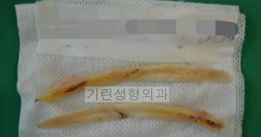안면윤곽 볼처짐에 관한 진실 : 티절골을 하면 왜 이중턱이 생길까 관련 이미지 3
