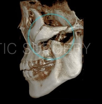 케이스에 맞는 광대뼈축소술 관련 이미지 7