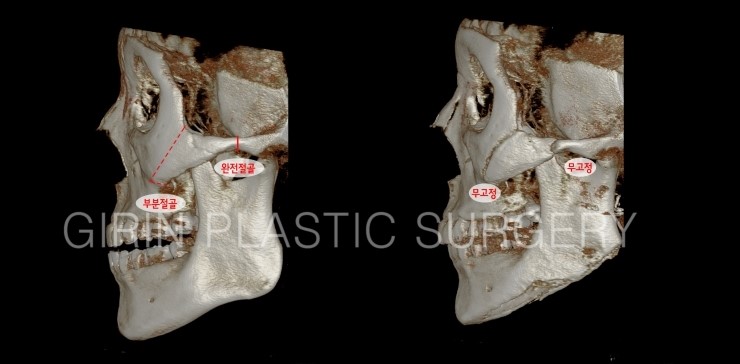 광대뼈수술하고 고정하지 않아도 안전한가요? 관련 이미지 2