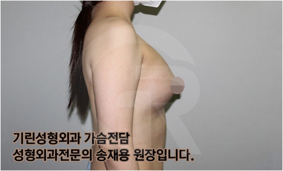 가슴확대수술 후 관리방법, 실제사례 알아보다. [기린성형외과의원_Dr.송재용] 관련 이미지 10