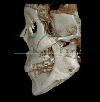 케이스에 맞는 광대뼈축소술 관련 이미지 9