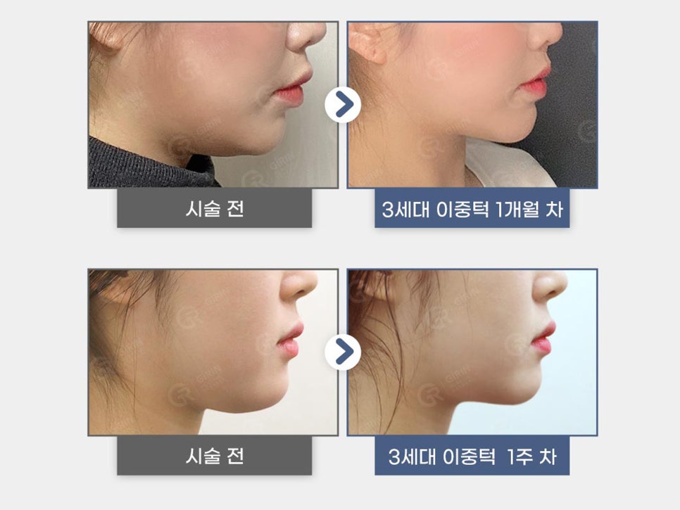 볼살윤곽주사 갸름한 라인 원한다면 관련 이미지 6
