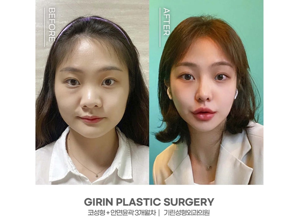 서울코수술 생김새에 따라 다르게 관련 이미지 1