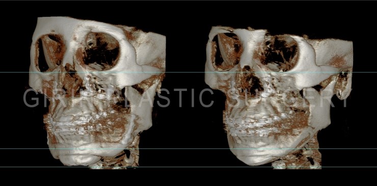 양악수술후 이차각, 라인불균형으로 인한 재수술 관련 이미지 3