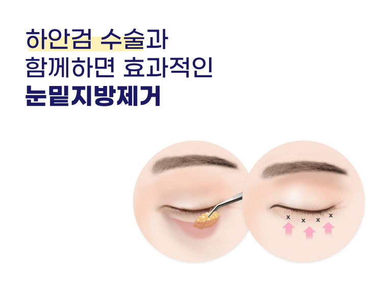 상하안검수술 인상을 바꾸기 위해 관련 이미지 14