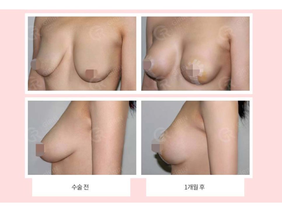 처진가슴성형 자신감 회복을 위해 관련 이미지 6