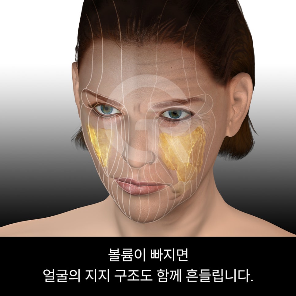 위고비&middot;마운자로 후 얼굴처짐으로 인한 미니거상 후기 관련 이미지 3