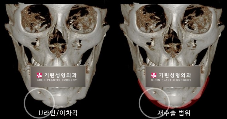 안면윤곽재수술 시 고려해야 할 점 관련 이미지 7