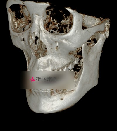 턱의 길이를 줄여주는 턱끝수술[앞턱길이줄임술] 관련 이미지 1