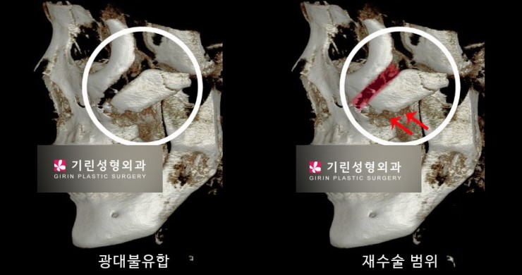 안면윤곽재수술 시 고려해야 할 점 관련 이미지 10