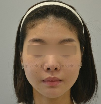 긴곡선 후 하관의 변화 ~한달 관련 이미지 2