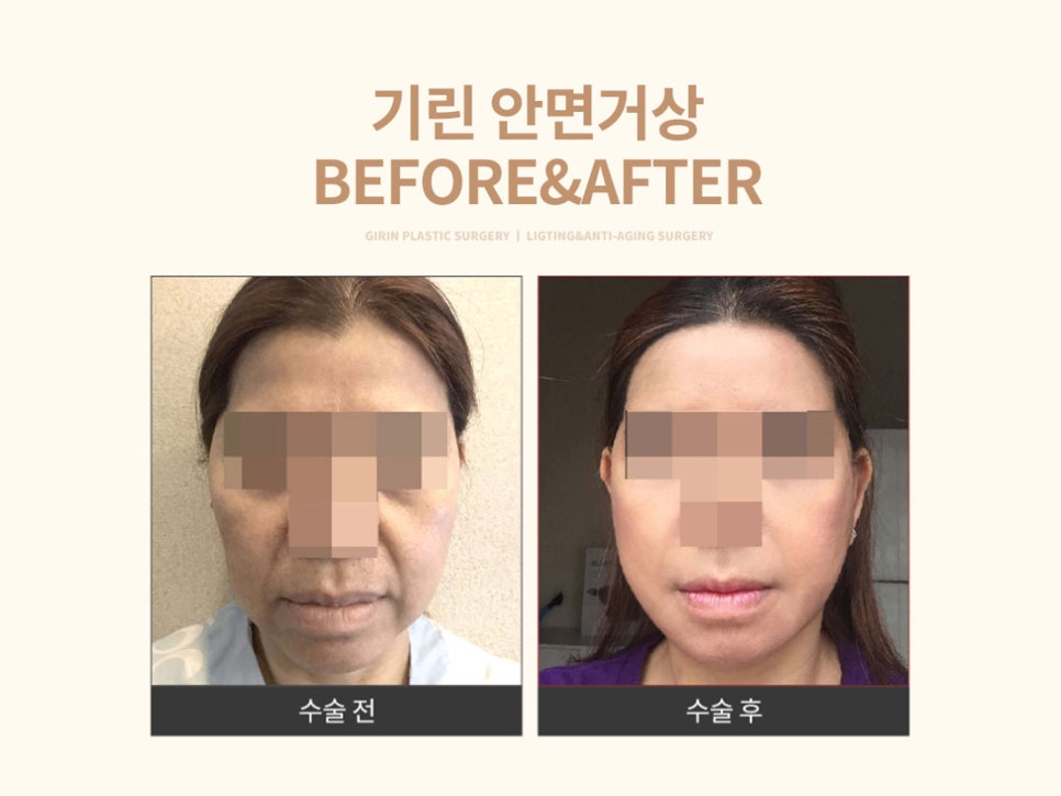 안면거상수술 효과 확실하려면 관련 이미지 15