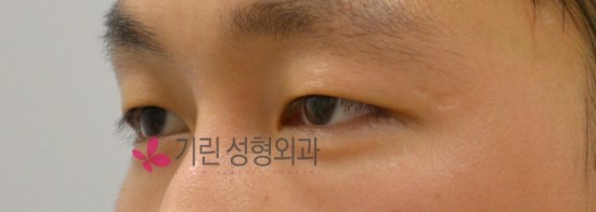 남자 쌍꺼풀수술 자연스럽게 ★ 관련 이미지 3