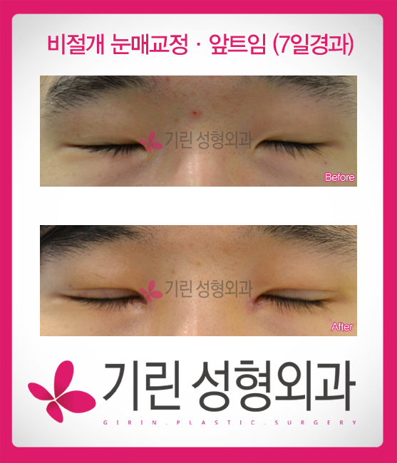 남자쌍꺼풀수술은 자연스럽게(전후사진) 관련 이미지 2