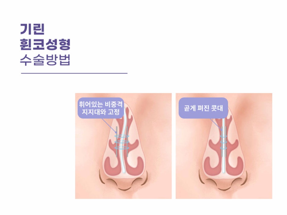 강남역성형외과유명한곳 얼굴에 맞춰 조화롭게 관련 이미지 15