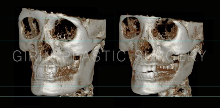 뉴브이라인, 아큐스컬프 6개월 경과 관련 이미지 2