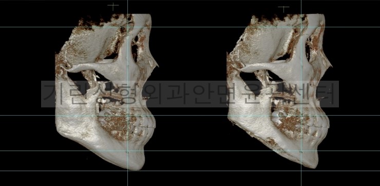 넓은턱수술+아큐스컬프+귀족 1달차 관련 이미지 5