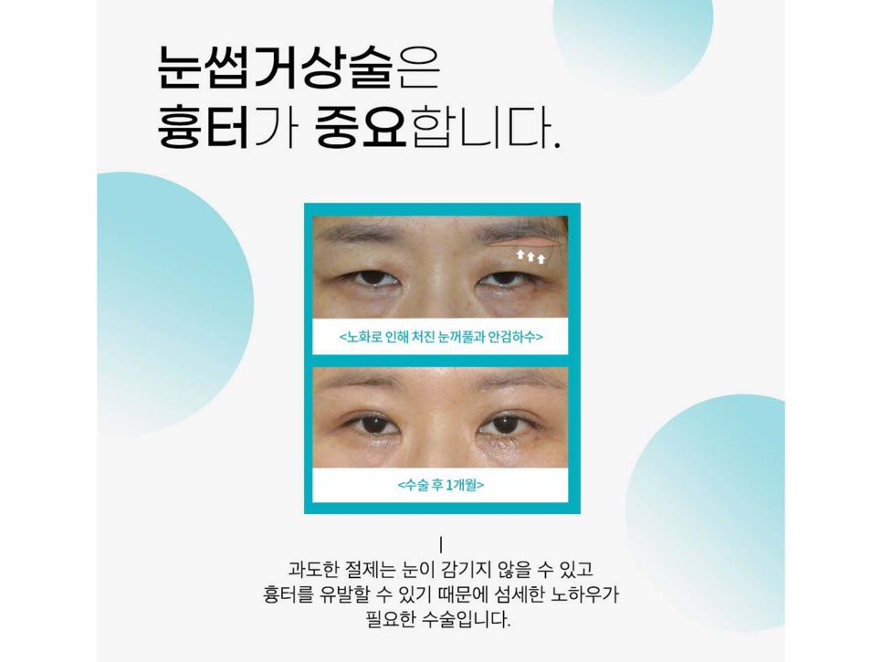 눈썹거상술흉터 걱정하고 있었다면 관련 이미지 7
