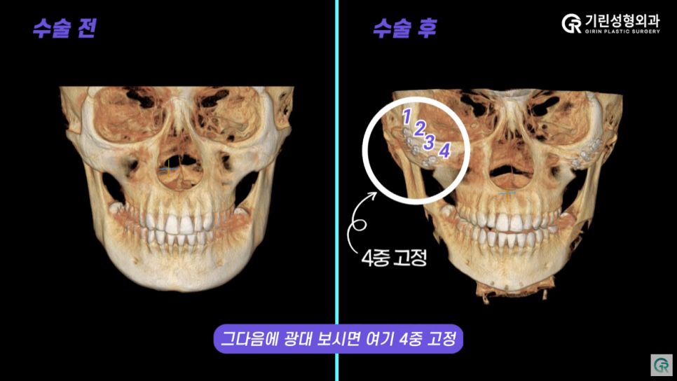 [기린성형외과의원] ❌보정어플은 당장 삭제❌_윤곽3종 수술일지 관련 이미지 9