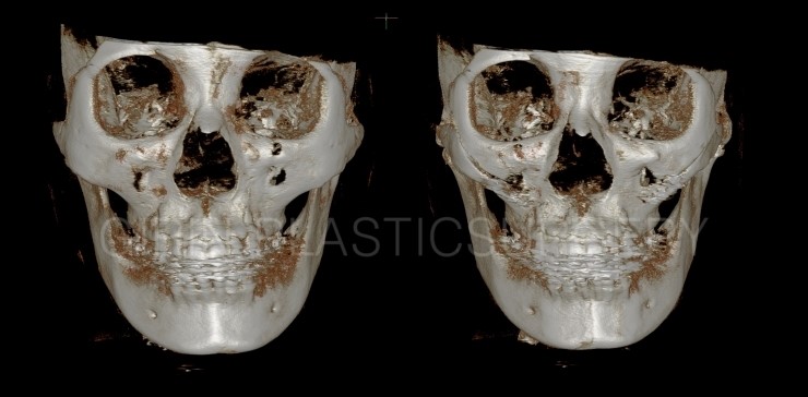 광대고정술 21일 경과 관련 이미지 2