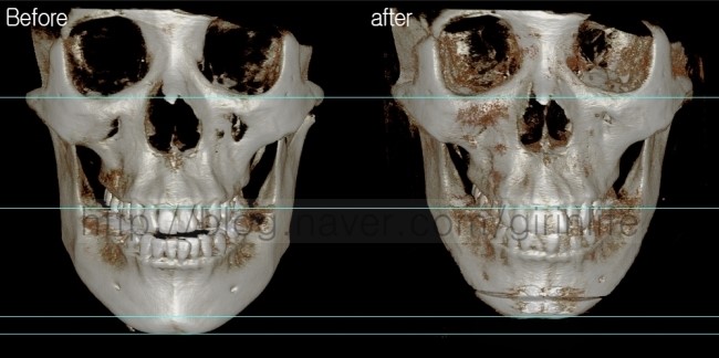 긴턱줄이는 수술 : 샌드위치절골사례 관련 이미지 2