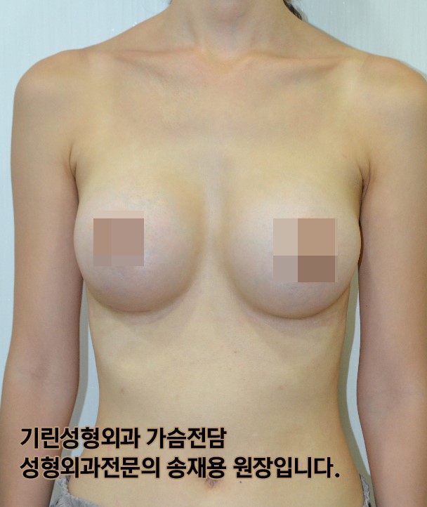 [가슴성형절개방식]밑선절개 흉터와 회복기간 (+실제사례) 관련 이미지 4