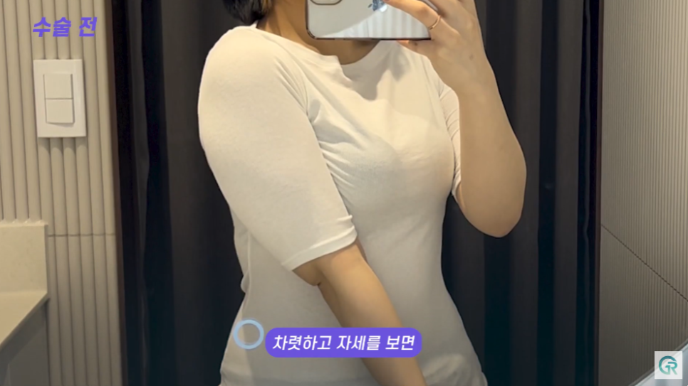 [기린성형외과] 뼈 팔뚝 된 비결 알려줄게_팔뚝 지방흡입 수술일지 관련 이미지 8