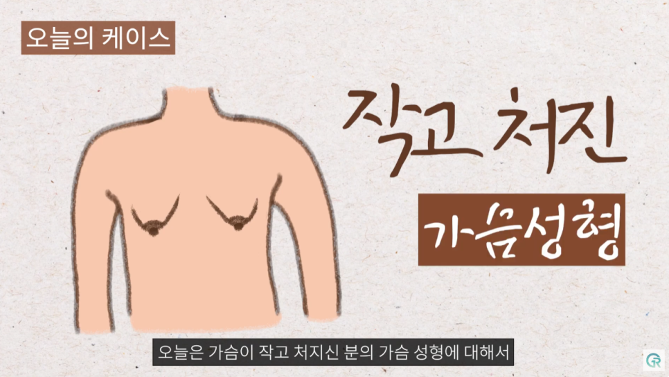 [기린성형외과의원] 다이어트 후 작고, 처진가슴 개선방법_가슴성형 수술일지 관련 이미지 2