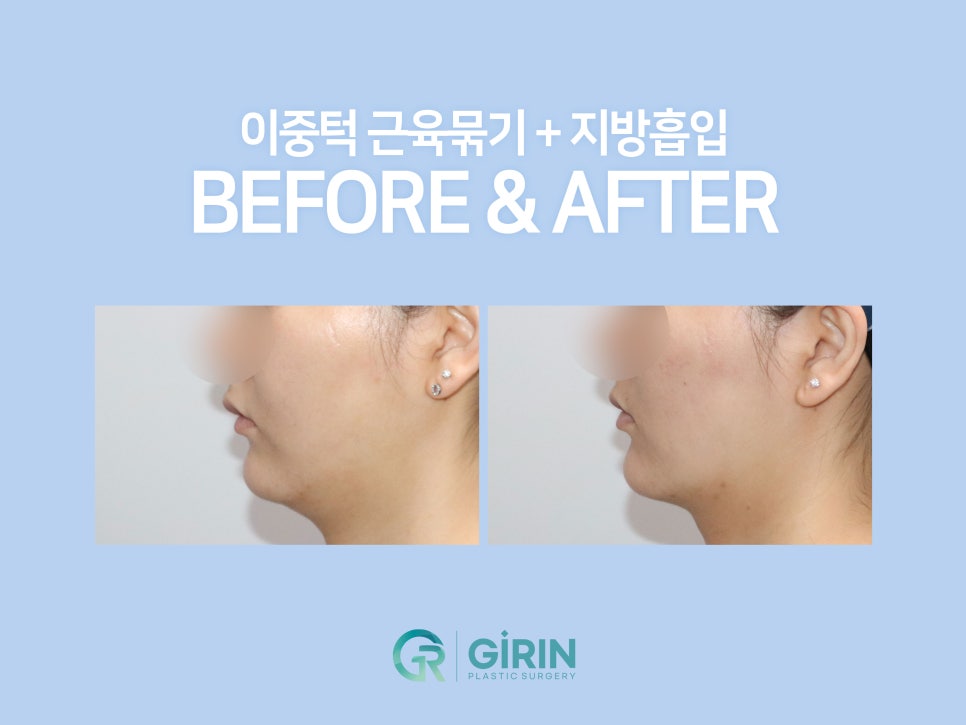 이중턱지방흡입 하나로 어렵다면? 관련 이미지 4