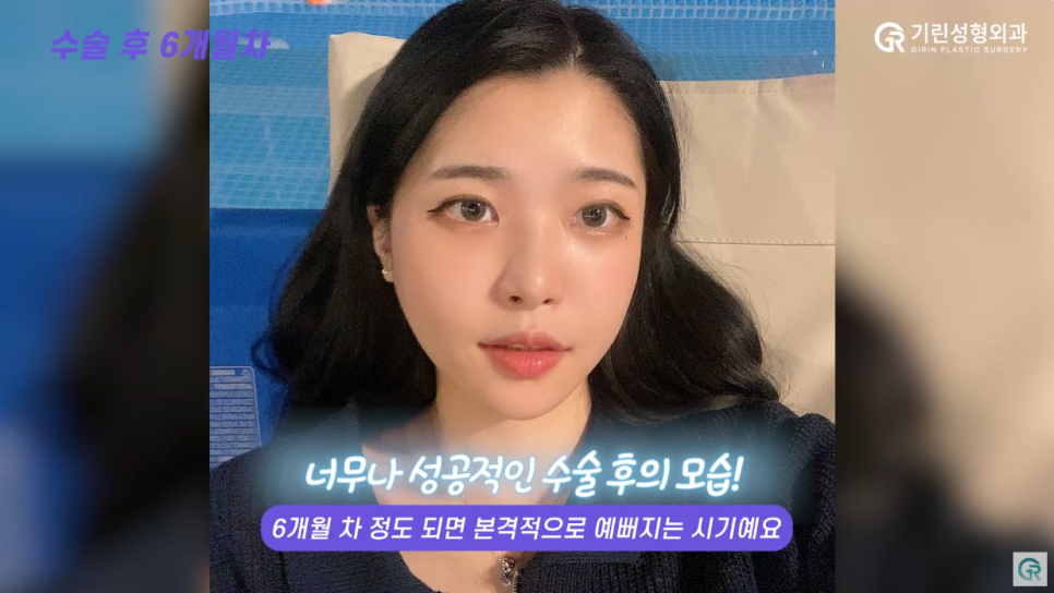 [기린성형외과의원] ❌보정어플은 당장 삭제❌_윤곽3종 수술일지 관련 이미지 12