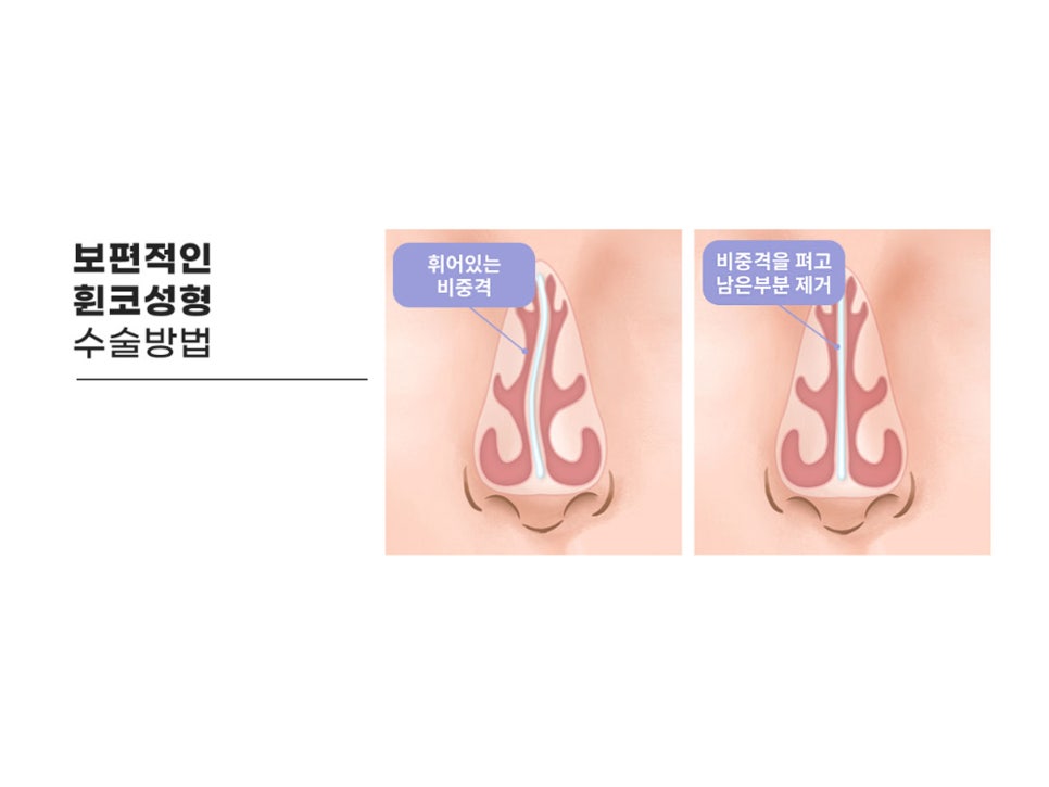 휜코성형잘하는곳 꼼꼼하게 따져보자 관련 이미지 9