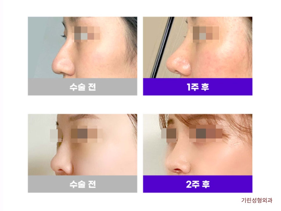 강남코재수술 신중하게 고르자 관련 이미지 7