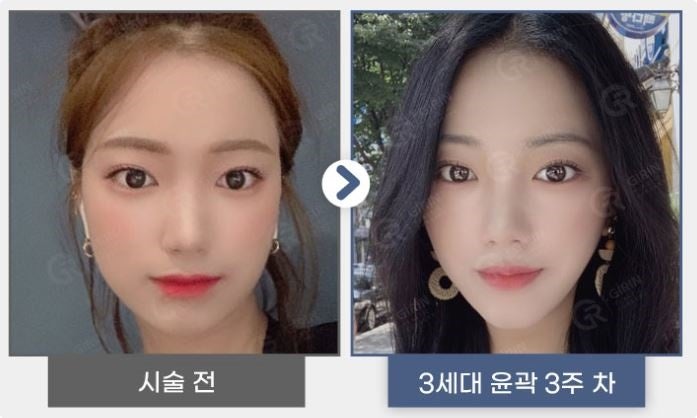 강남지방분해주사, 의미 없는 유형은? 관련 이미지 4