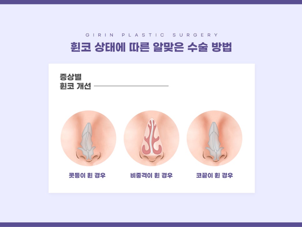 휜코성형잘하는곳 꼼꼼하게 따져보자 관련 이미지 7