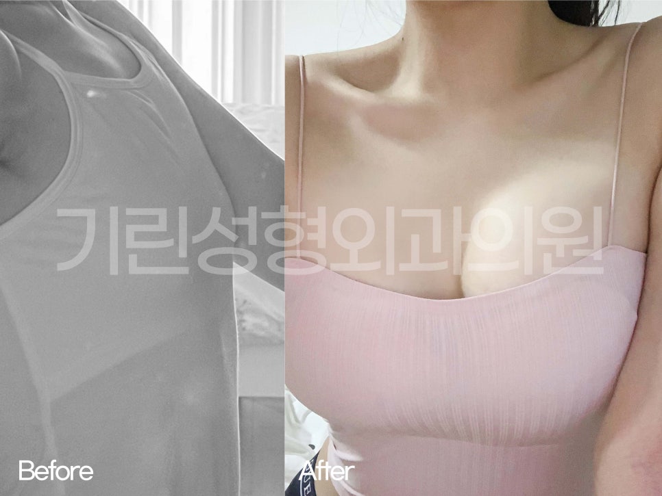 가슴성형전후 비교가 필요하다면 관련 이미지 2