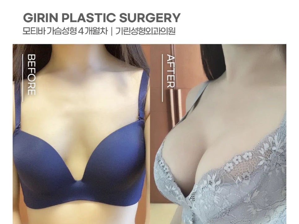 가슴확대수술후기 맞춤으로 알아봐야 관련 이미지 2