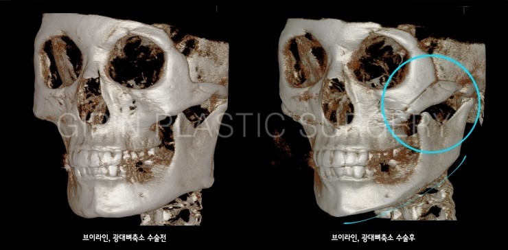 브이라인, 광대고정술 5개월경과 관련 이미지 5