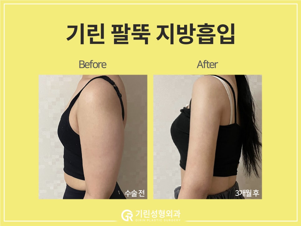 [기린 성형외과] 예쁜 라인 찾는 체형별 팔뚝지방흡입 관련 이미지 14