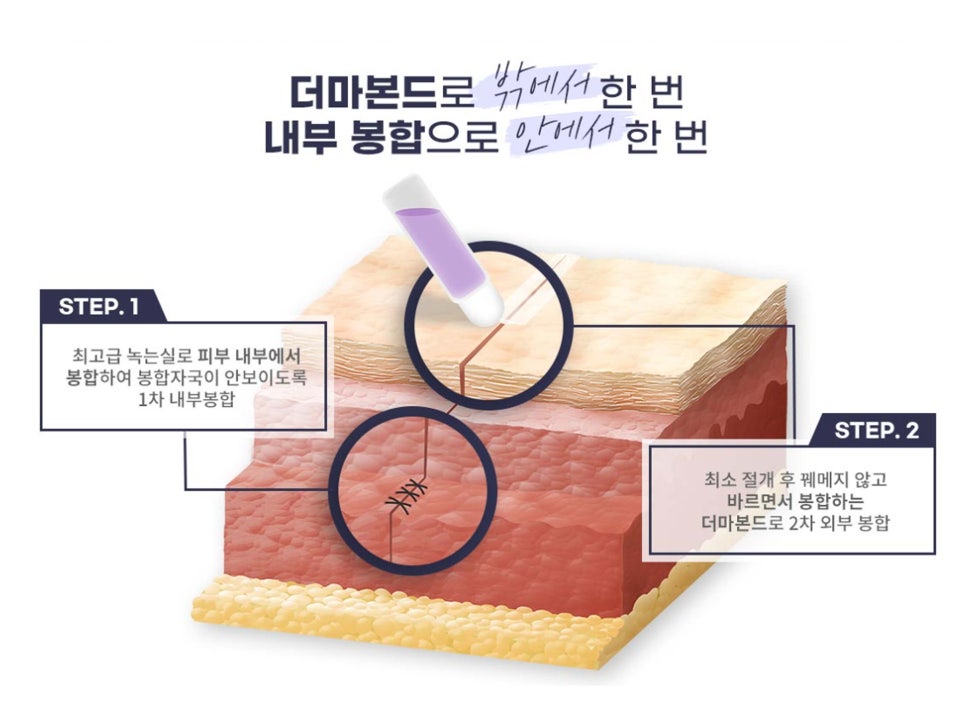 처진가슴성형 자신감 회복을 위해 관련 이미지 10